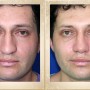 12 – Rinoplastia Primaria