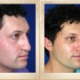 13 – Rinoplastia Primaria